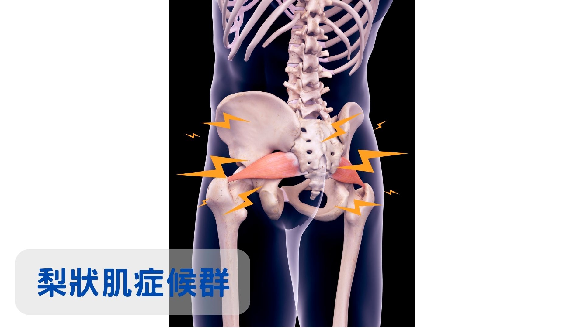 鶯歌復健-鶯歌物理治療-梨狀肌症候群治療