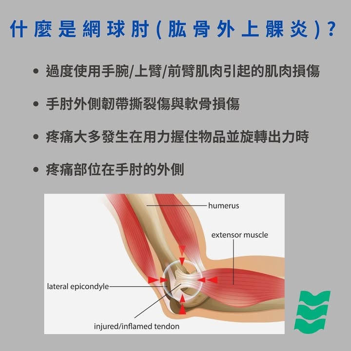 什麼是網球肘(肱骨外上髁炎)
