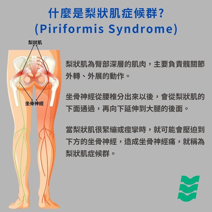 梨狀肌症候群(Piriformis Syndrome)