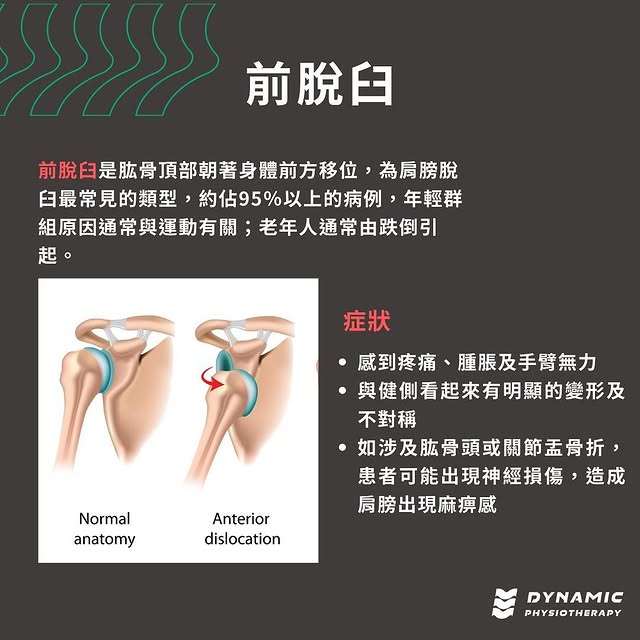 班卡式病變(前下關節唇撕裂)