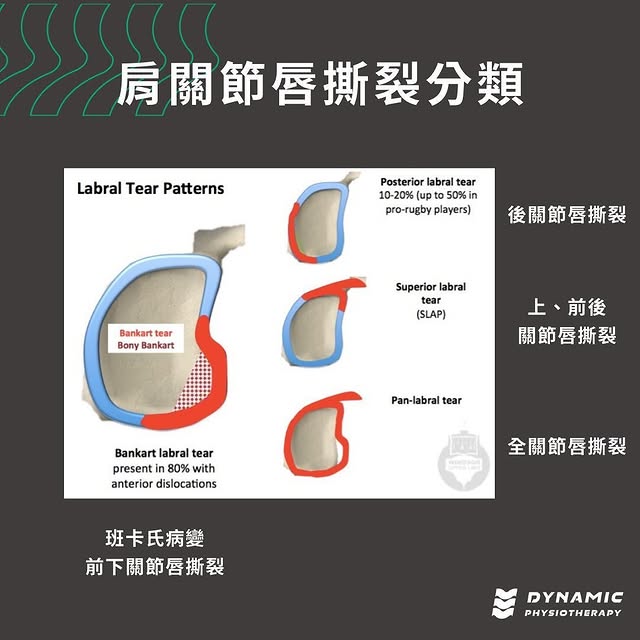 班卡式病變(前下關節唇撕裂)