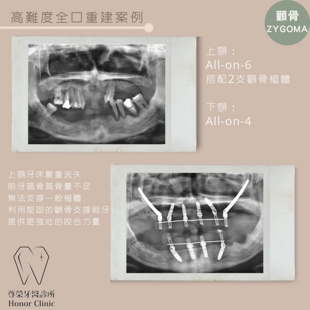 高難度全口重建