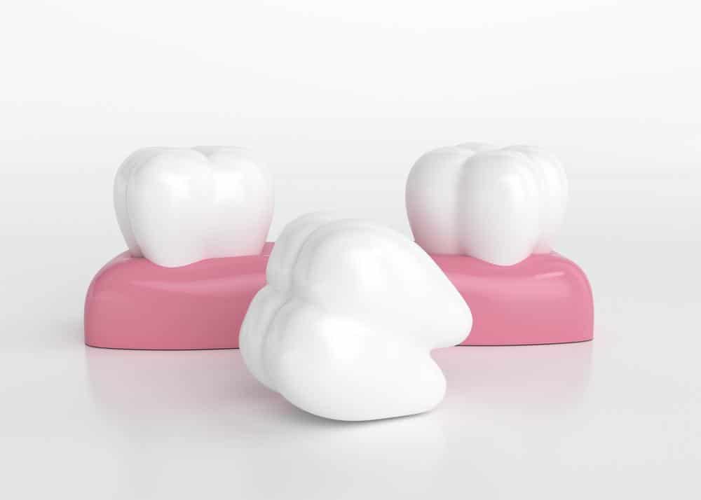 拔臼齒要植牙嗎？