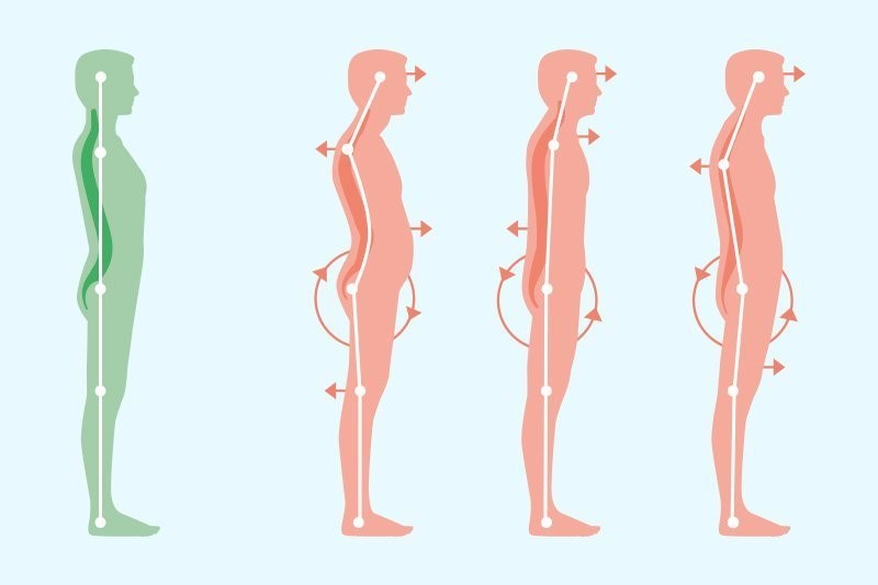 (站姿也是影響駝背的重要因素之一。圖片來源：Comprehensive Spine Care)