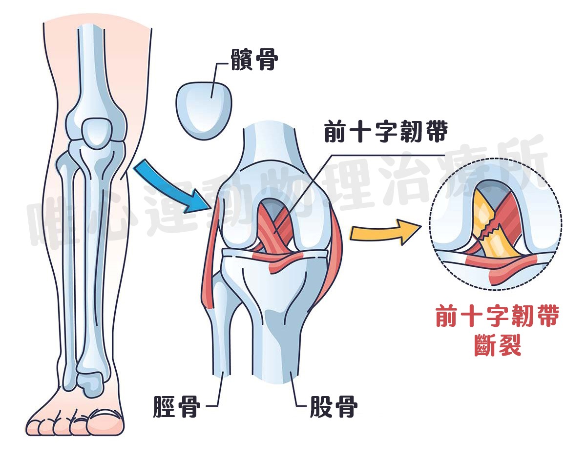(圖片來源：唯心運動物理治療所 製圖)