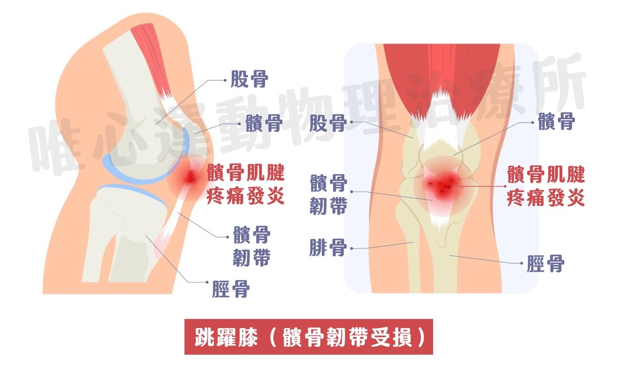 (圖片來源：唯心運動物理治療所 製圖)