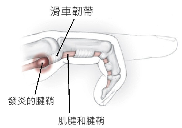 板機指的原理其實就是滑車韌帶卡住了。(圖片製作： 唯心運動物理治療所)